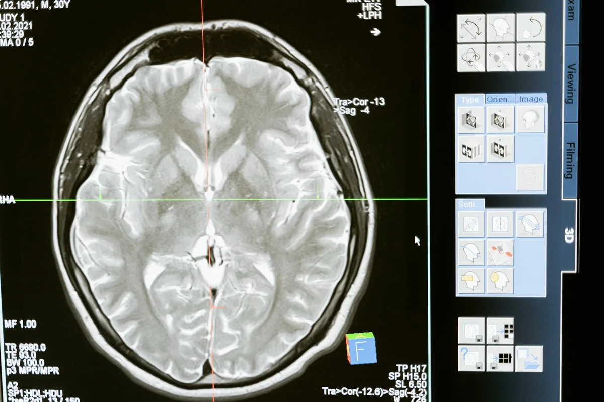 Pensamiento extendido Claude Opus: cuándo pagar por pensar m... — Intricate MRI brain scan displayed on a computer screen for medical analysis and
